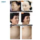wrinkle removal device